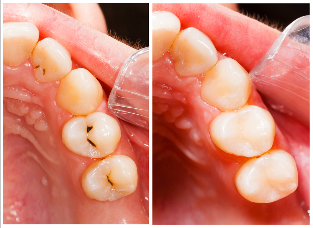 Aesthetic Fillings