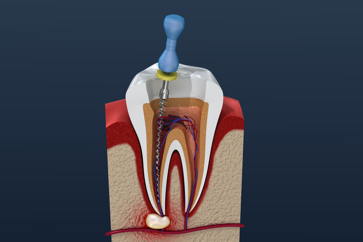 Endodontic Treatment