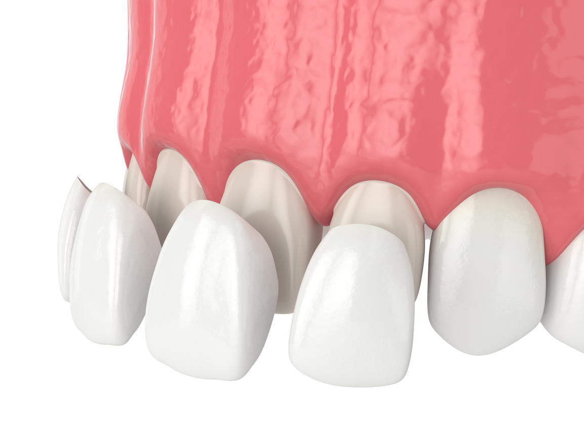 Porcelain Veneers